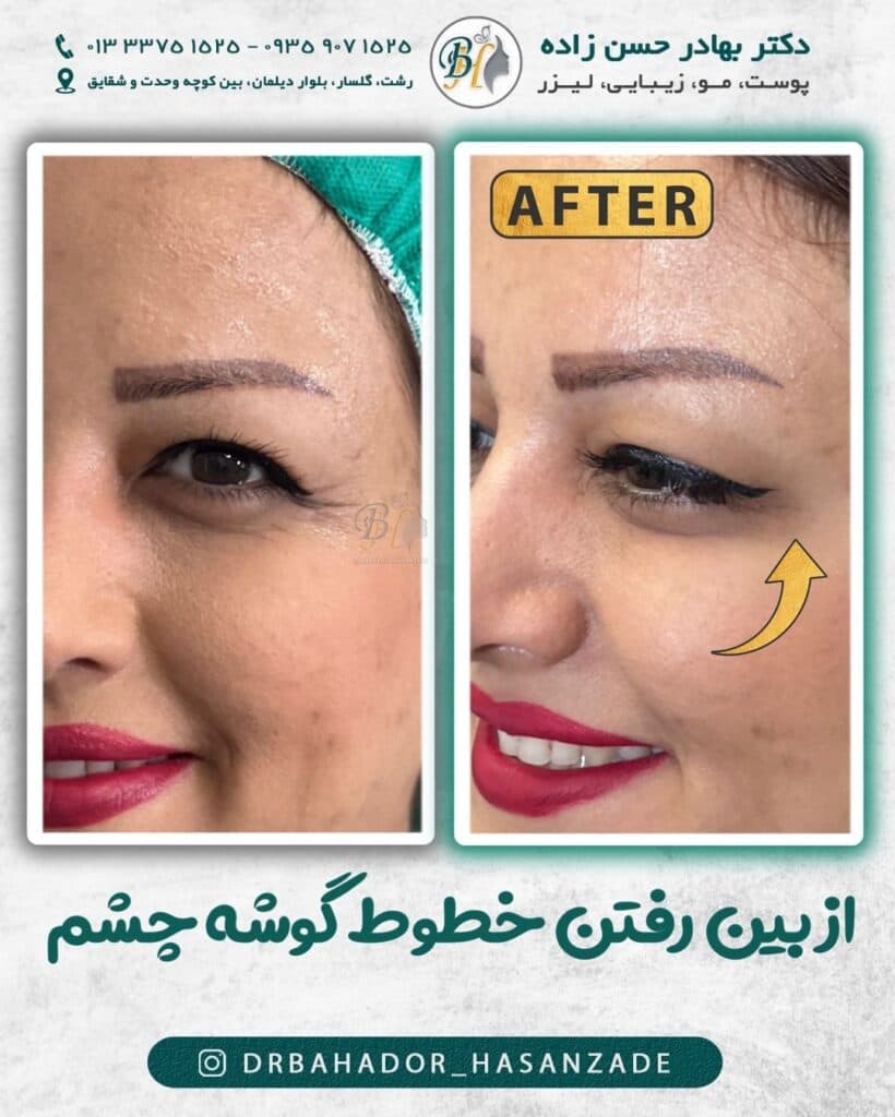 کلینیک زیبایی ژل لب خط خنده گونه دکتر بهادر حسن زاده در گلسار رشت