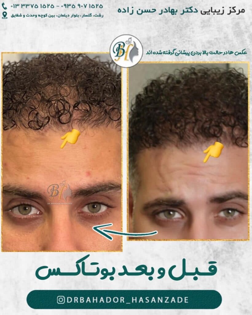 کلینیک زیبایی ژل لب خط خنده گونه دکتر بهادر حسن زاده در گلسار رشت