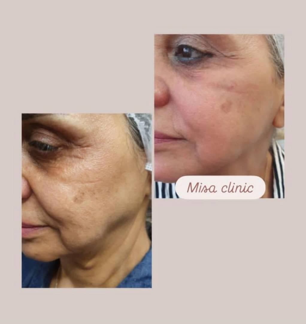 مرکز تخصصی جوانسازی فیشیال پوست میسا در کیش