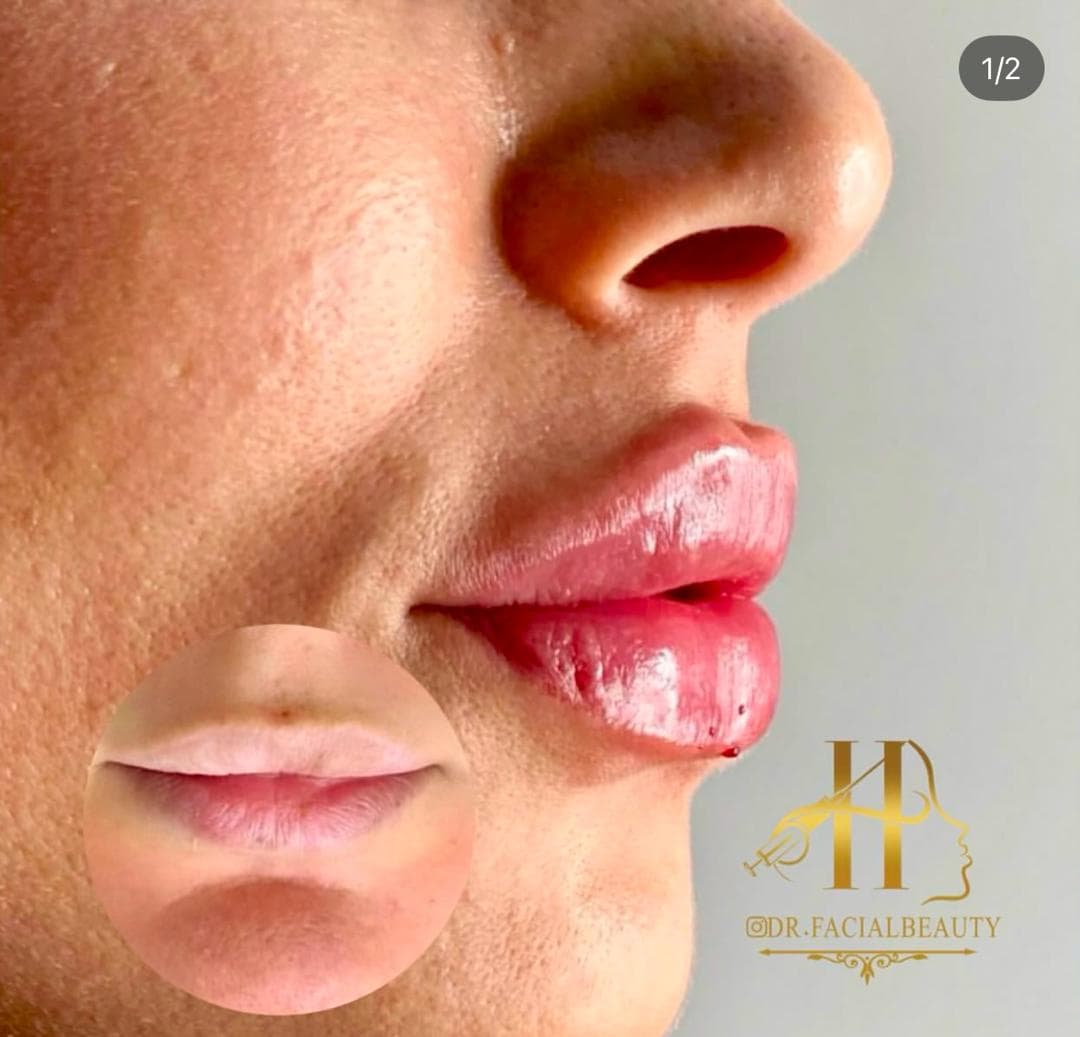 آموزش و خدمات تخصصی تزریق فیلر و بوتاکس هستی قپانوری در کرمانشاه