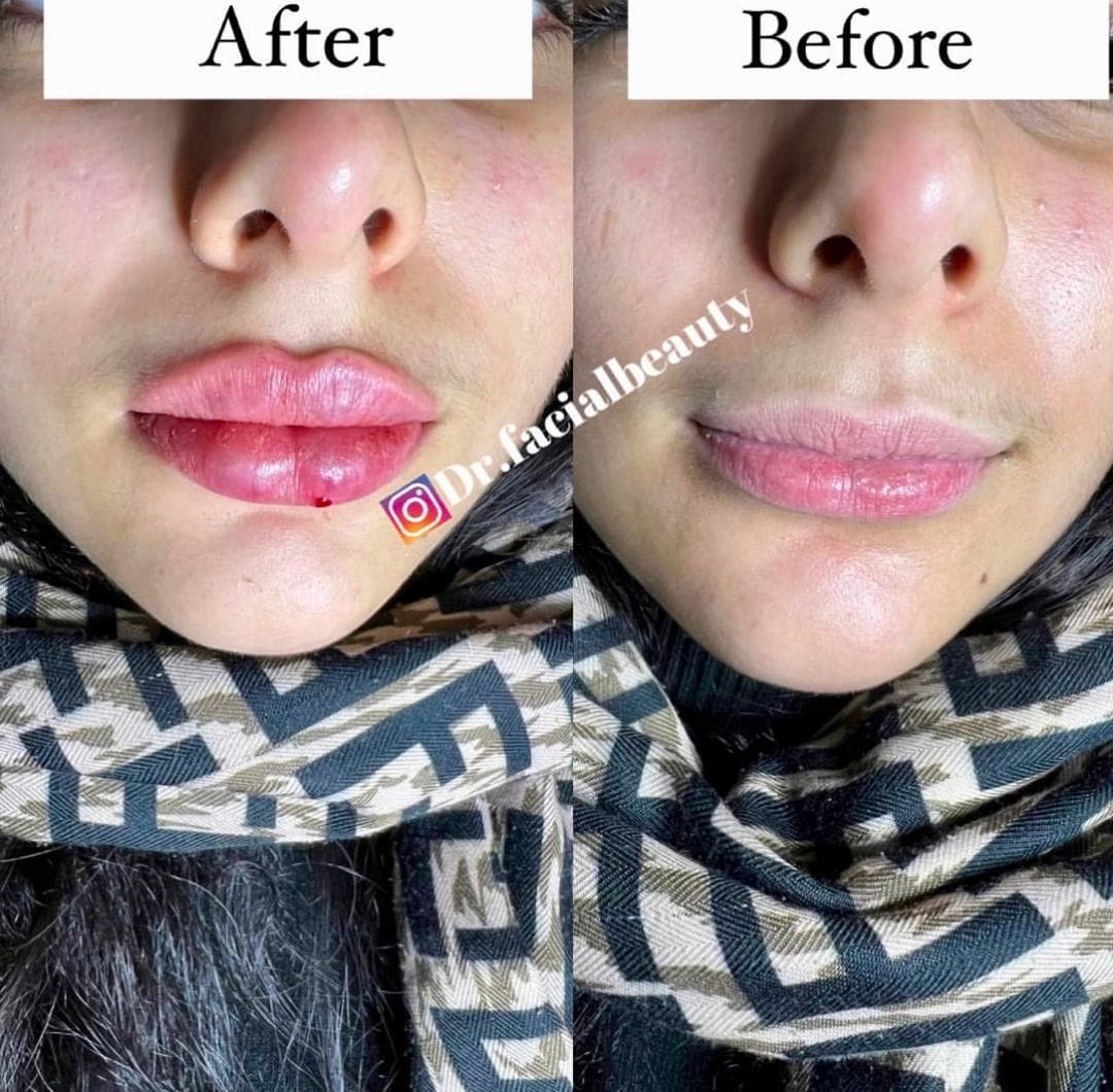 آموزش و خدمات تخصصی تزریق فیلر و بوتاکس هستی قپانوری در کرمانشاه