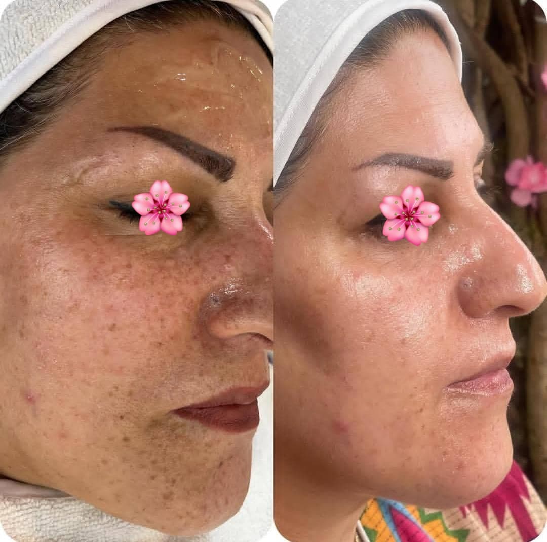 آموزش خدمات پاکسازی و مراقبت از پوست زینب نبی زاده در بابل