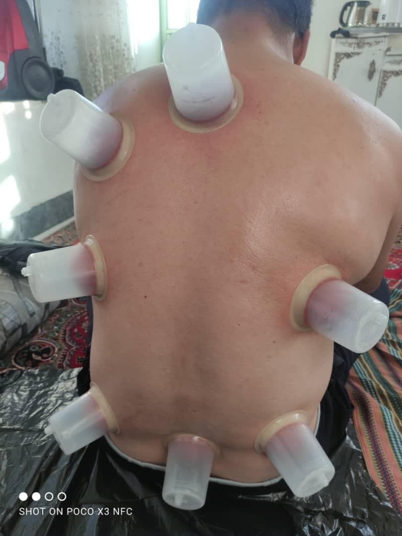 خدمات تخصصی حجامت و زالو درمانی رایحه سیب طبیب امکی در ایلام