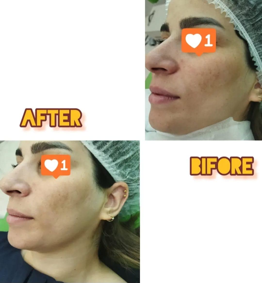 آموزش و درمان جوش و اسکار مرضیه سجادیان در کرمانشاه