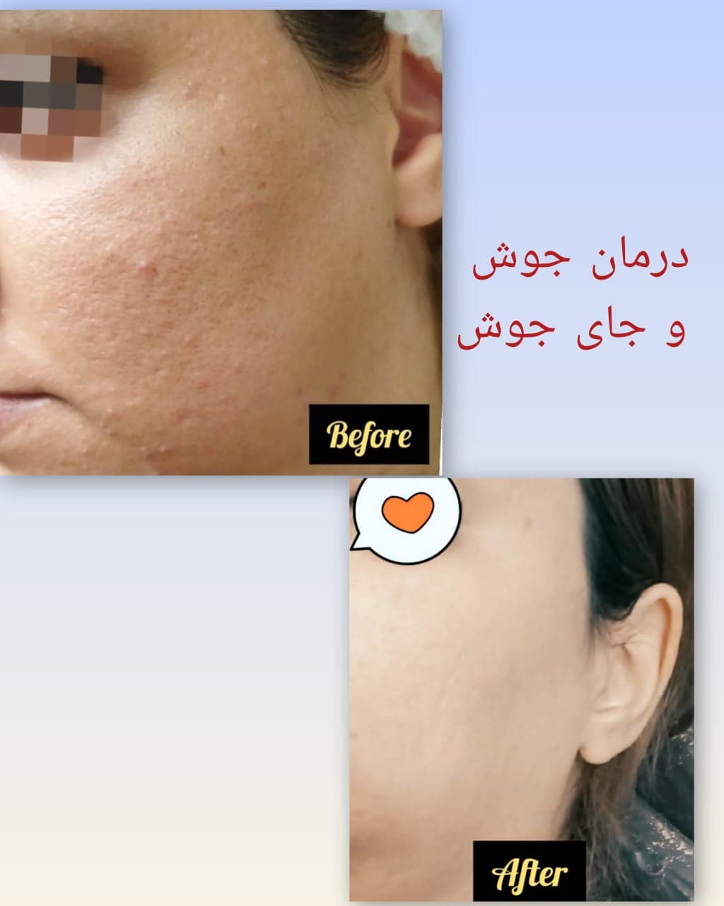 آموزش و درمان جوش و اسکار مرضیه سجادیان در کرمانشاه