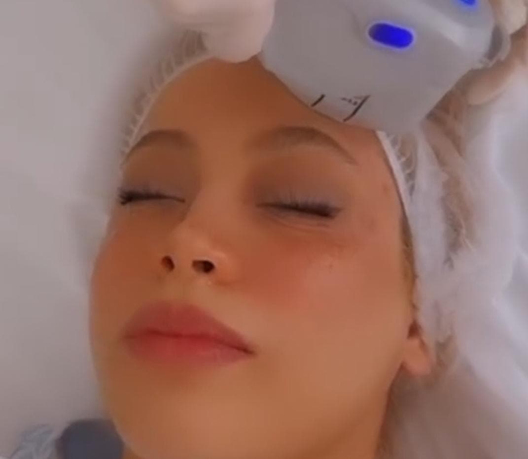 آموزش و درمان جوش و اسکار مرضیه سجادیان در کرمانشاه