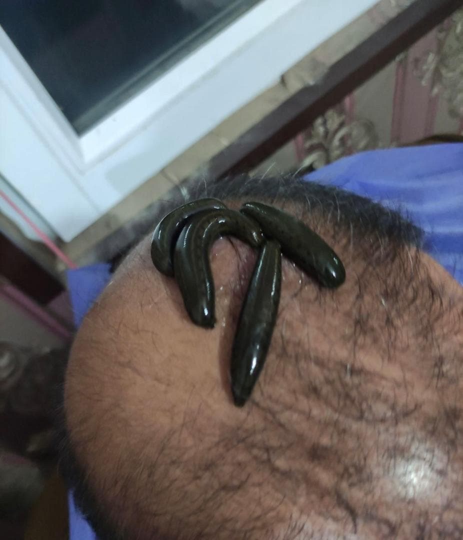 خدمات تخصصی حجامت و زالو درمانی رایحه سیب طبیب امکی در ایلام