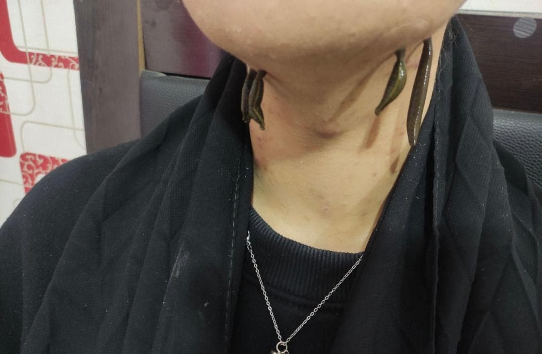 خدمات تخصصی حجامت و زالو درمانی رایحه سیب طبیب امکی در ایلام